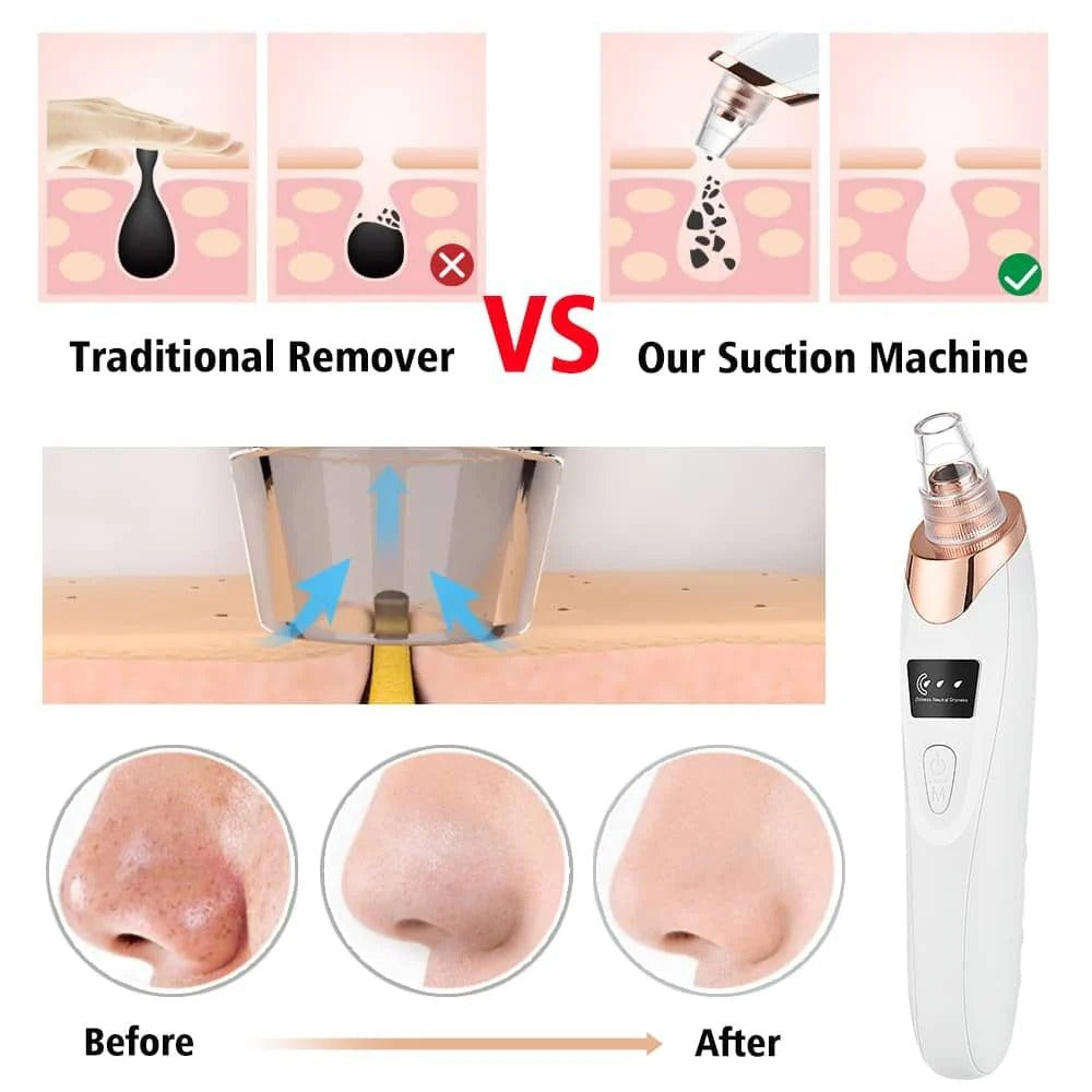 Electric Blackhead Remover Vacuum Pore Cleaner